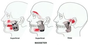 Masseter