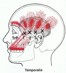 Temporalis